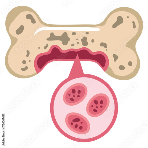 Sarcoma bone cancer awareness survivor icon isolated vector illustration ribbon symbol medical health support awareness concept for cancer visuals