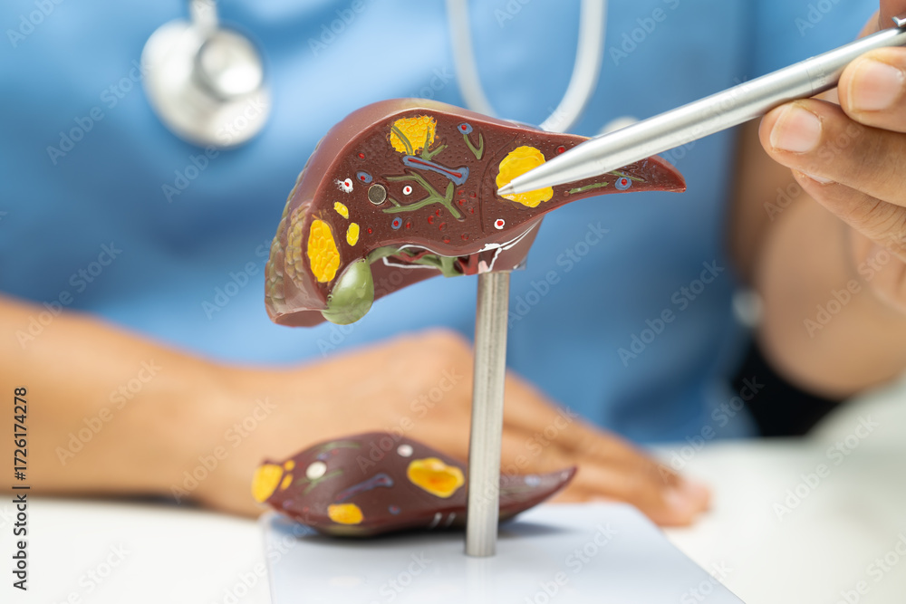 Fototapeta premium Cirrhosis, Liver cancer, fatty liver, Asian doctor with liver human anatomy model in World Hepatitis Day at hospital.