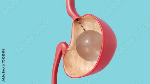 Quadro su tela A 3d rendering of gastric balloon, or an intragastric balloon, is a non-surgical, temporary medical device used to promote weight loss in patients with obesity or significant overweight