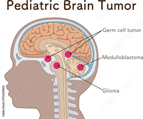 小児 こどもの脳腫瘍　Childhood brain tumors