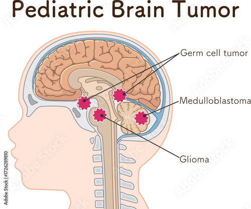 小児 こどもの脳腫瘍　Childhood brain tumors