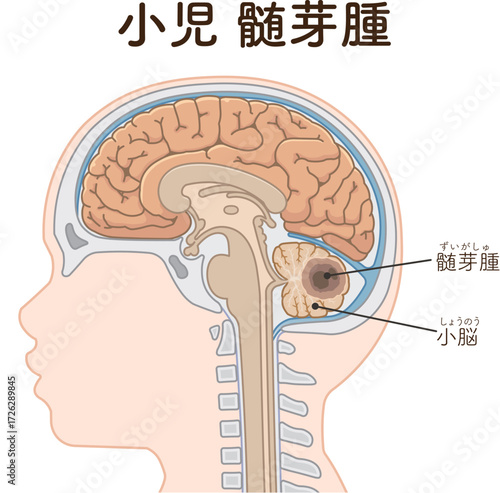 小児 こどもの脳腫瘍　Childhood brain tumors