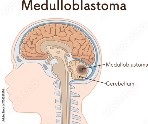 小児 こどもの脳腫瘍　Childhood brain tumors