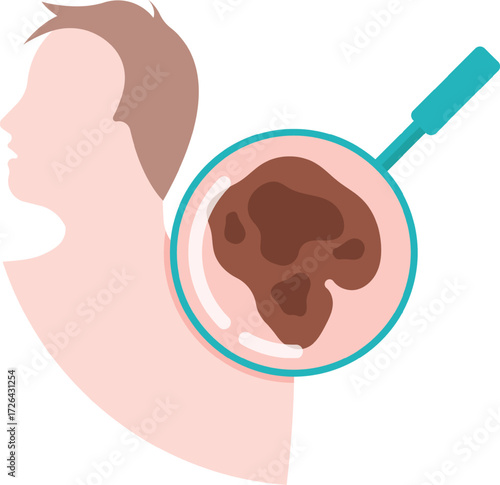 Vector art of a magnifying glass examines a brown mole on a persons neck, highlighting skin cancer awareness and the importance of early detection