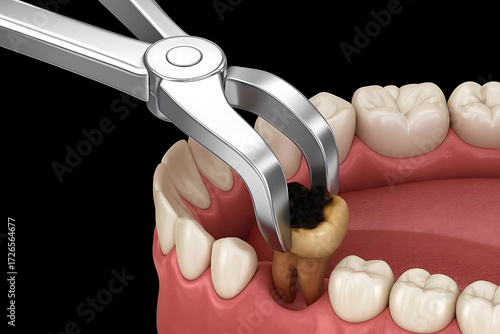 Extraction of Molar tooth damaged by caries
