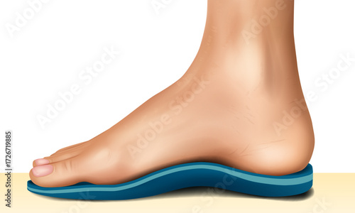 Realistic medical illustration of a human foot with an orthopedic insole, showing arch support and correction for flat feet. Anatomical side view of foot wearing orthopedic sole
