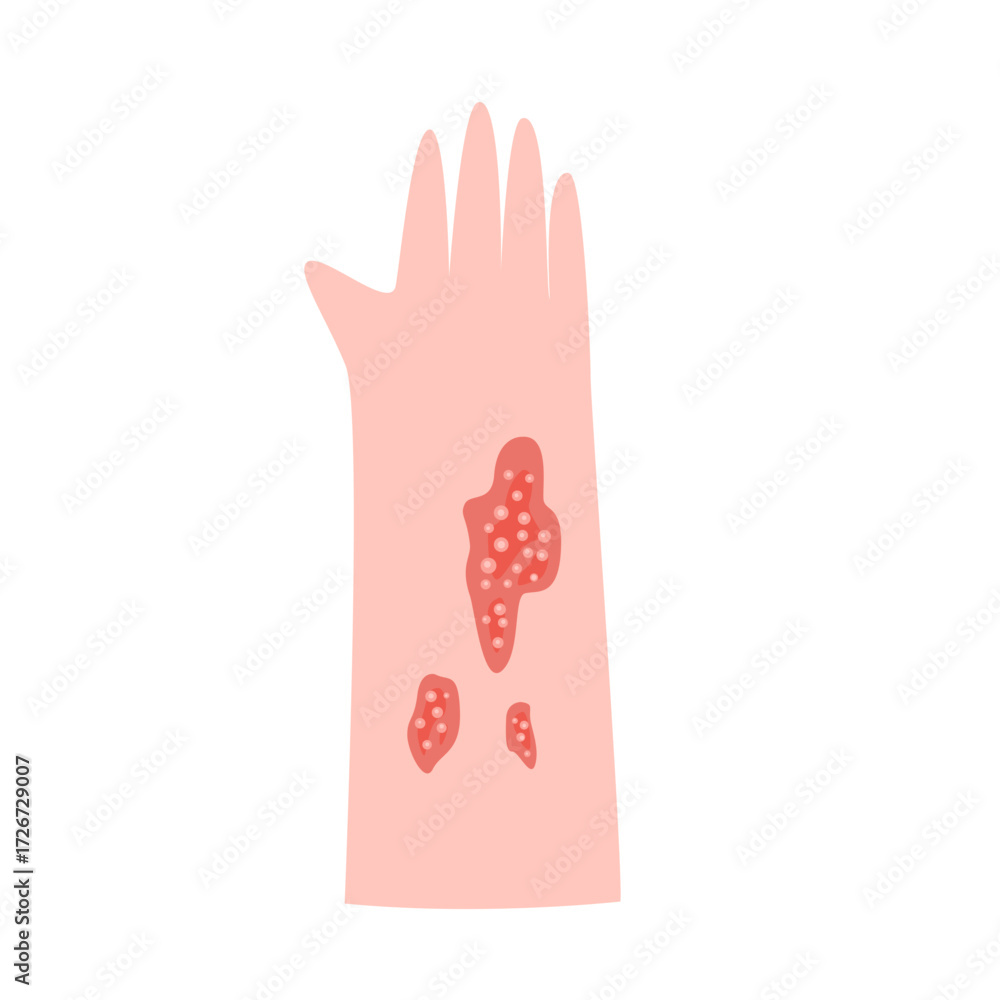 Obraz premium zoster virus infection disease concept