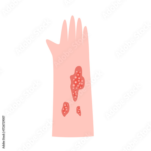 zoster virus infection disease concept