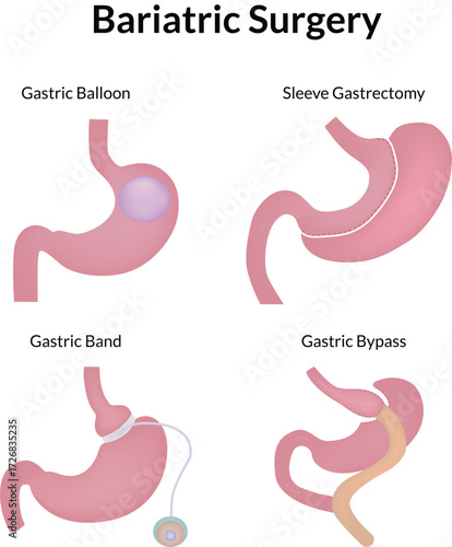 Bariatric Surgery Procedures Gastric Balloon Sleeve Band and Bypass Vector Illustration