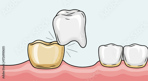 Dental crown illustration with gold tooth prepared for fitting. Showing restoration of a tooth using a dental crown illustration,