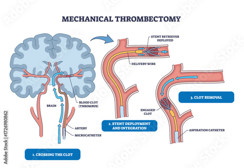 Mechanical thrombectomy diagram shows brain, artery, and stent illustrating clot crossing, stent deployment, and clot removal steps. Outline diagram