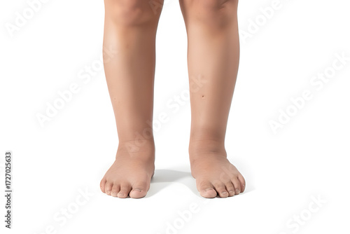 Wallpaper Mural Adult's legs showing significant bilateral pedal edema on white background
Description Torontodigital.ca