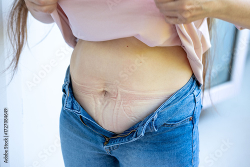 Postpartum belly, Post-baby body, stretch marks, woman's abdomen, woman unbuttoning jeans, skin texture, motherhood, body positivity