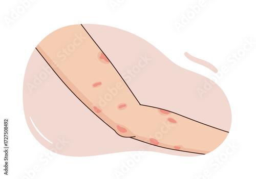 Skin with hives on a simple background - blisters of different sizes are located randomly, the color is soft, without bright contrasts, the emphasis is on realistic texture
