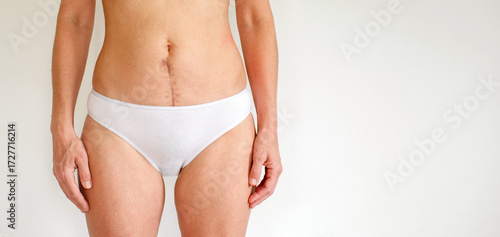 Woman's body with a scar on her abdomen from a surgical suture five months after gynecological surgery (hysterectomy), or after giving birth by cesarean section, close-up, copy space.