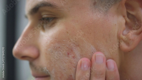 Young man applying acne controlling face wash for men to stop skin breakouts and acne scars, side view close up. Skin problem and disorder concepts.