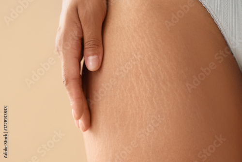 Young woman with stretch marks on her leg against beige background, closeup