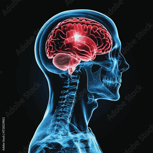 Side view X-ray image of a human skull showing a highlighted red area in the brain, indicating a stroke or brain injury. , vector style simple color