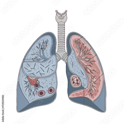 Crosssection human lungs illustrating internal structure and potential abnormalities, including lesions and inflammation