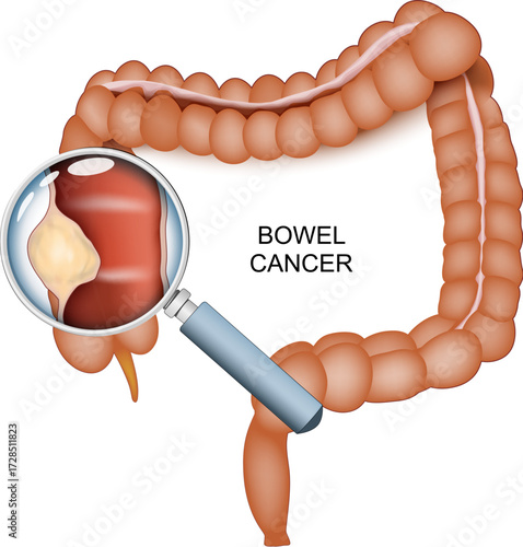Bowel cancer. Colorectal cancer. Human large intestine. malignant tumor through a magnifying glass