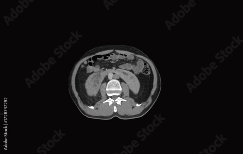 horseshoe kidney  ct scan abdomen 
A horseshoe kidney is a congenital condition where a  two kidneys fuse together, typically at the lower poles,