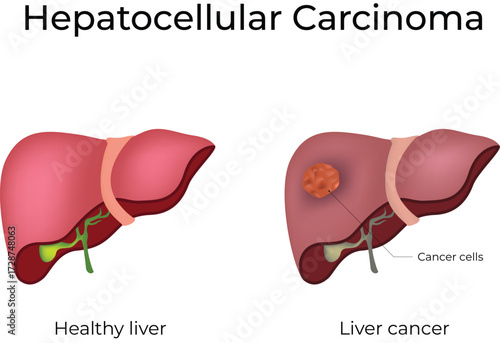 Hepatocellular Carcinoma: Healthy Liver vs Liver Cancer