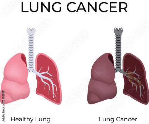 Lung Cancer Comparison Healthy vs Affected Lungs