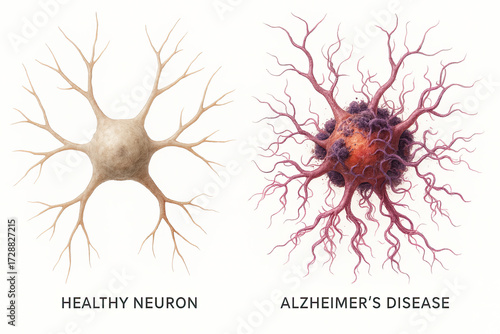 Comparison of a Healthy Neuron and a Neuron Affected by Alzheimer's Disease