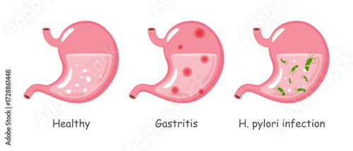 Stomach with medical condition including healthy, gastritis, Helicobacter pylori infection . Cartoon illustration . Isolated white background . Vector .