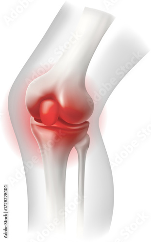 medical illustration of a human knee joint, viewed from the side red focus on the bones to indicate pain, inflammation, or injury. The surrounding soft tissue