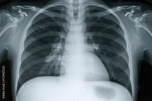 PA chest X-ray revealing uniform opacities in the left lower lung area indicative of loculated pleural effusion caused by tuberculosis