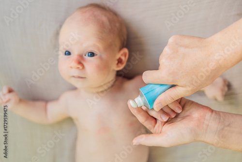 Mother applying anti-rash cream on baby skin. Heat rash treatment and skincare for newborns. Infant skin protection and baby hygiene concept