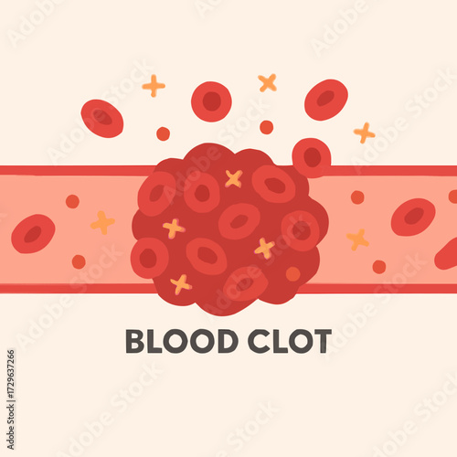 A flat vector illustration of a blood clot forming inside a blood vessel, showing red blood cells and platelets in a simplified medical style