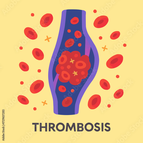 A flat vector illustration of a vein with a thrombosis clot, surrounded by flowing blood cells in a vibrant, educational style