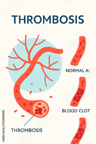 A flat vector illustration of a medical infographic about thrombosis, showing blood vessels and clots in a clean, flat design