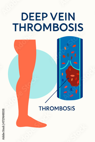 A flat vector illustration of a thrombosis clot in a leg vein, symbolizing deep vein thrombosis in a bold, medical style