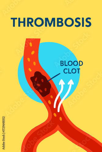 A flat vector illustration of a thrombosis clot blocking blood flow in an artery, shown in a vibrant, simplified style