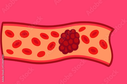 A flat vector illustration of a blood vessel with a thrombosis clot, surrounded by healthy blood cells in a vibrant design
