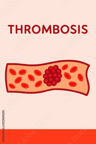 A flat vector illustration of a blood vessel with a thrombosis clot, designed as a medical poster graphic