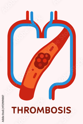 A flat vector illustration of a thrombosis clot in a simplified circulatory system, with a focus on health education