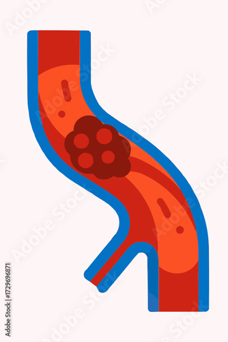 A flat vector illustration of a thrombosis clot in a stylized vein, with a focus on vibrant medical visuals