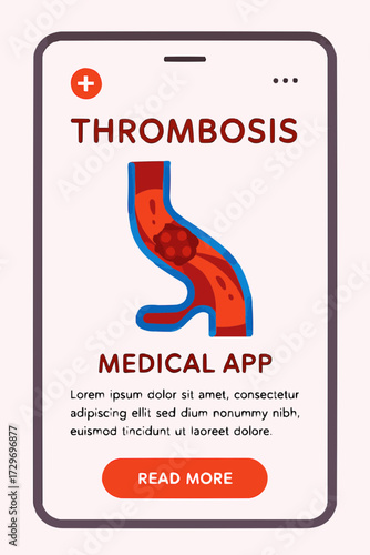 A flat vector illustration of a medical app interface showing thrombosis information, designed in a clean style