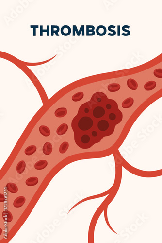 A flat vector illustration of a thrombosis clot in a stylized circulatory system, with a focus on medical education