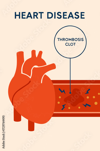A flat vector illustration of a thrombosis clot in a heart artery, designed for heart disease awareness