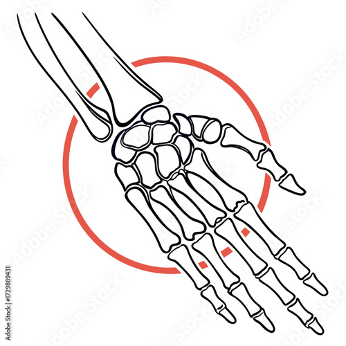 A stylized line drawing of a human hand skeleton with a red circle highlighting the metacarpal and phalangeal bones indicating a focus on hand anatomy and potential injury or medical concern