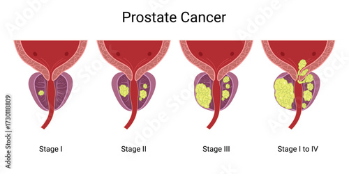 Prostate Cancer. Prostate Tumor. Normal Prostate and Enlarged Prostate Gland under Bladder. Normal prostate and prostate with cancer. Prostatitis is inflammation of the prostate gland. 
