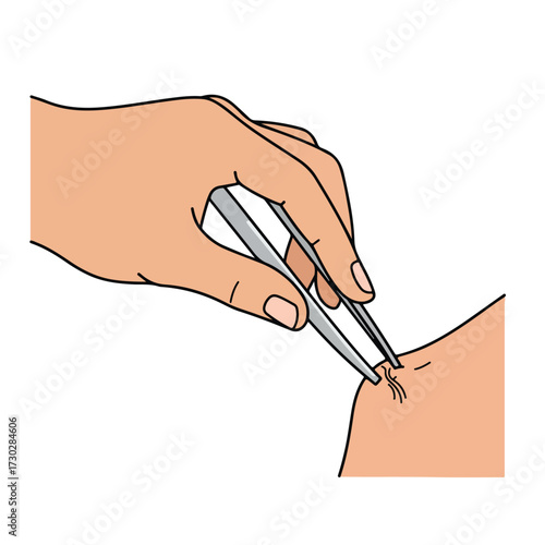 Hand using tweezers to extract something from skin