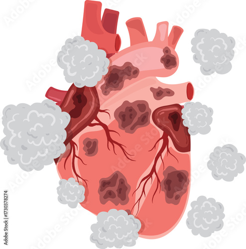 Heart Disease Anatomical Representation of Damaged Heart