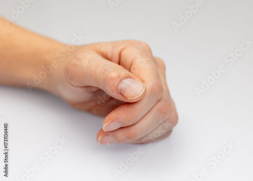 Fotografie Close-up of an aging human hand showing a cyst or lump on the finger joint near the nail