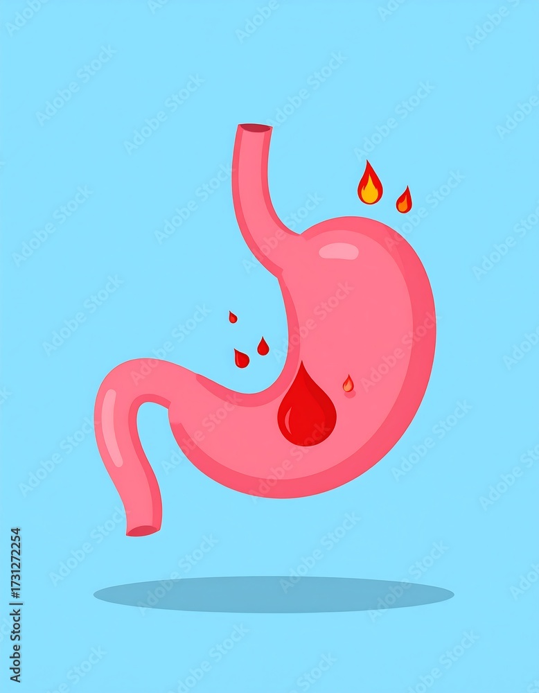 Fototapeta premium Stomach Ulcer Illustration.